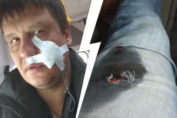 «Выстрелил в лицо». Новосибирец оказался в больнице после конфликта с бизнесменом